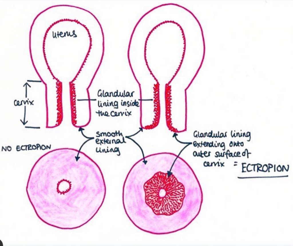 Cervical Ectropion - What Are The Symptoms?