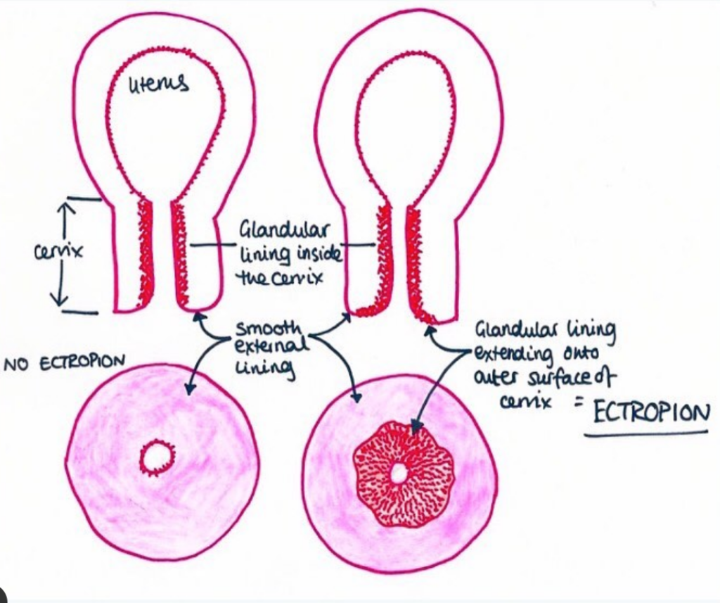 Cervical Ectropion Symptoms Causes Treatment The Lowdown