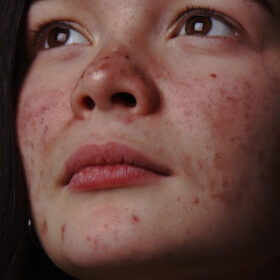 Acne Image