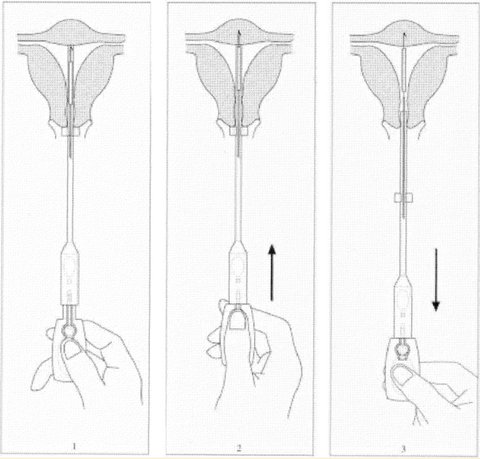 Anchoring process for GyneFix