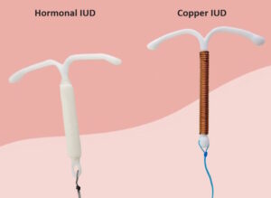 Types of IUD